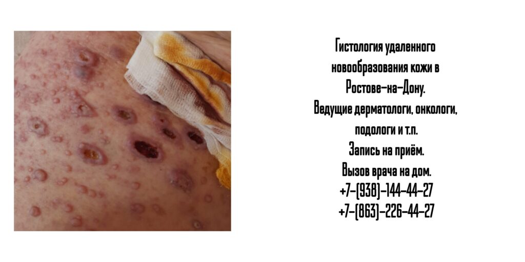 Дерматолог и онкодерматолог в Ростове-на-Дону - гистология