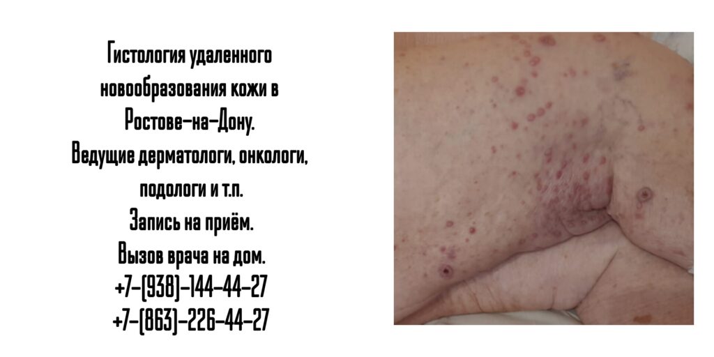 Дерматолог и онкодерматолог в Ростове-на-Дону - гистология