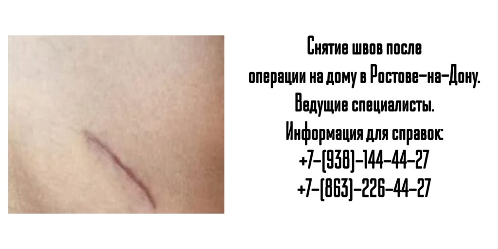 Снять послеоперационные швы на дому в Ростове-на-Дону