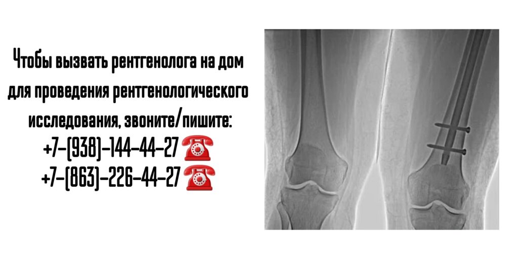 Рентген на дому- вызов врача на дом в Ростове-на-Дону 
