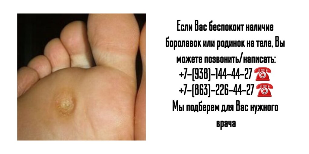 Удаление бородавок и родинок в Ростове-на-Дону