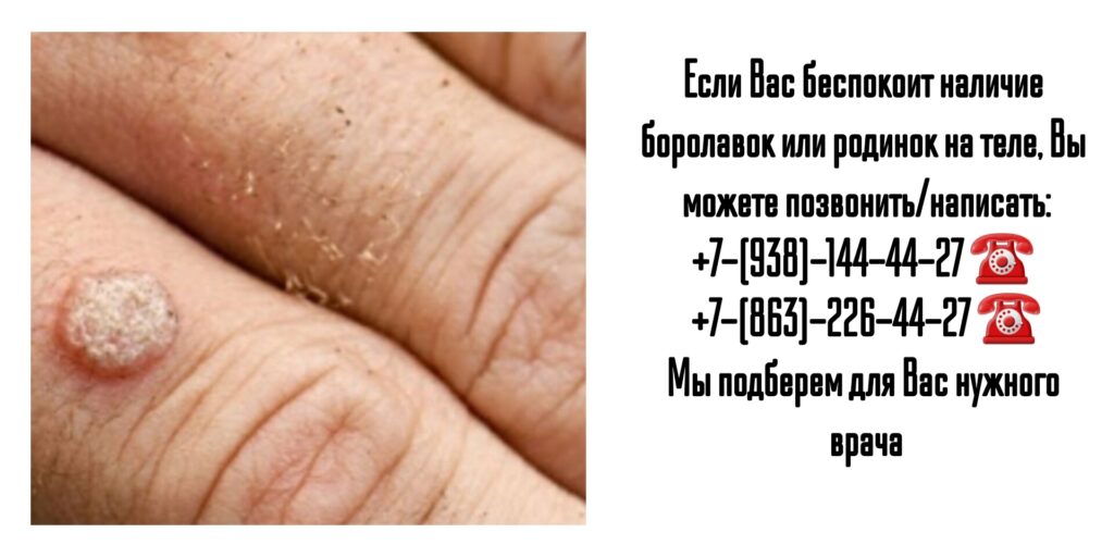 Удаление бородавок и родинок в Ростове-на-Дону
