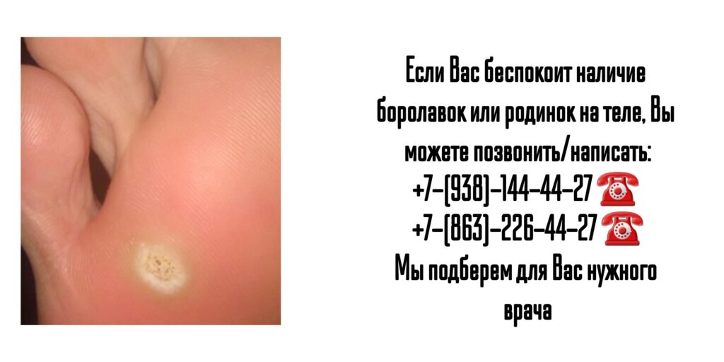 Удаление бородавок и родинок в Ростове-на-Дону