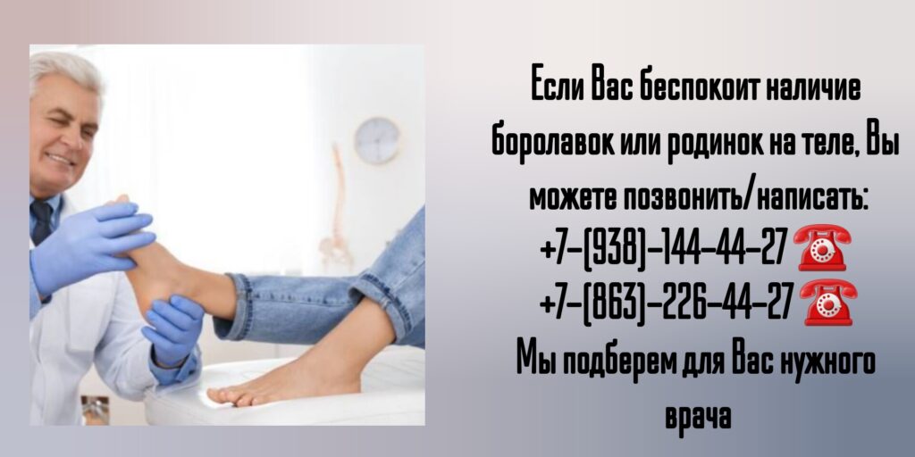 Удаление бородавок и родинок в Ростове-на-Дону