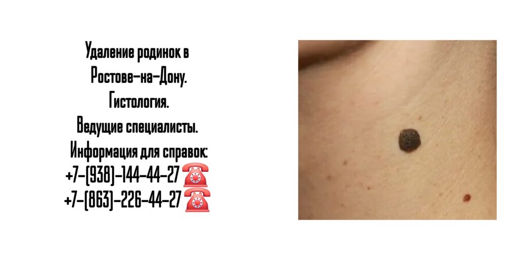 Удаление родинки в Ростове-на-Дону 