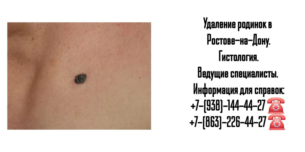 Удаление родинки в Ростове-на-Дону 