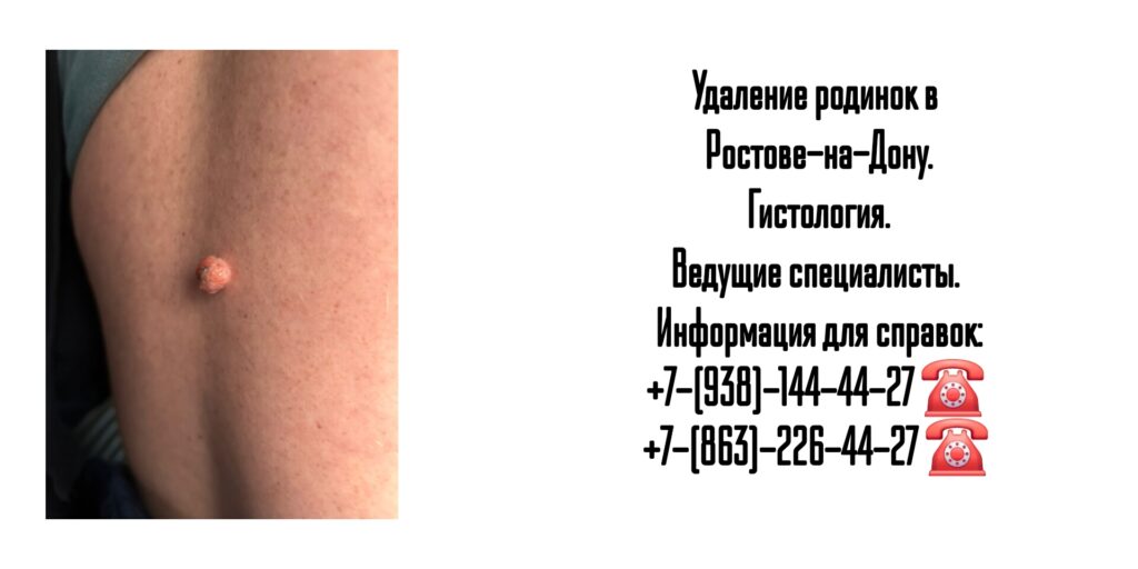 Удаление родинки в Ростове-на-Дону 
