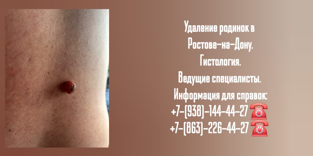Удаление родинки в Ростове-на-Дону 
