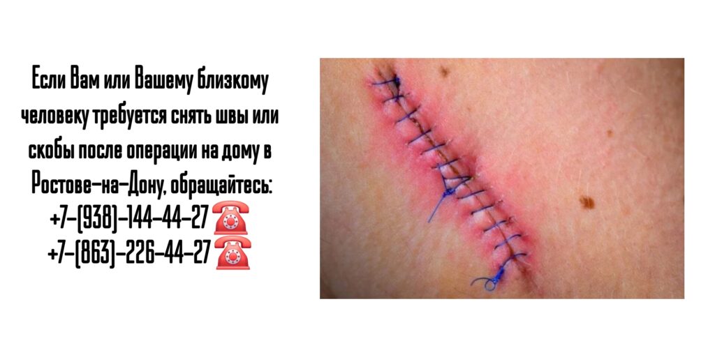 Снять швы на дому после операции- Ростов-на-Дону 
