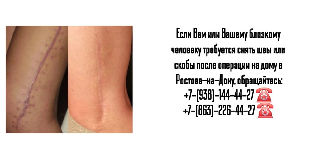 Снять швы на дому после операции- Ростов-на-Дону 