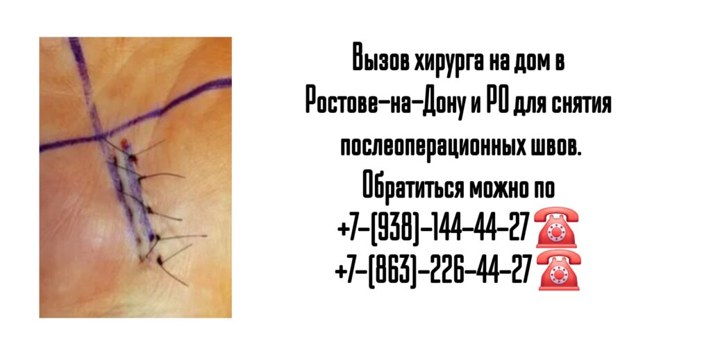 Снятие послеоперационных швов на дому Ростов 