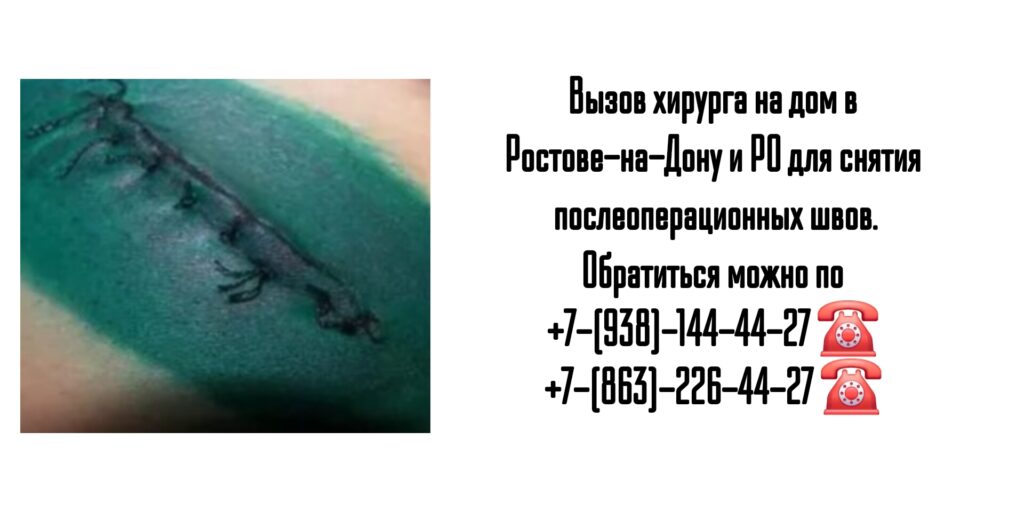 Снятие послеоперационных швов на дому Ростов 