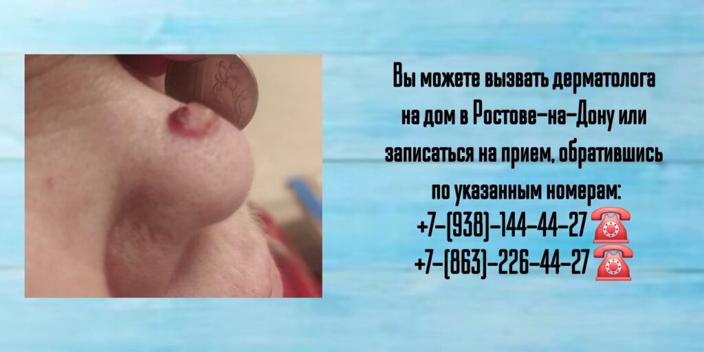 Вызов дерматолога на дом - Ростов-на-Дону 