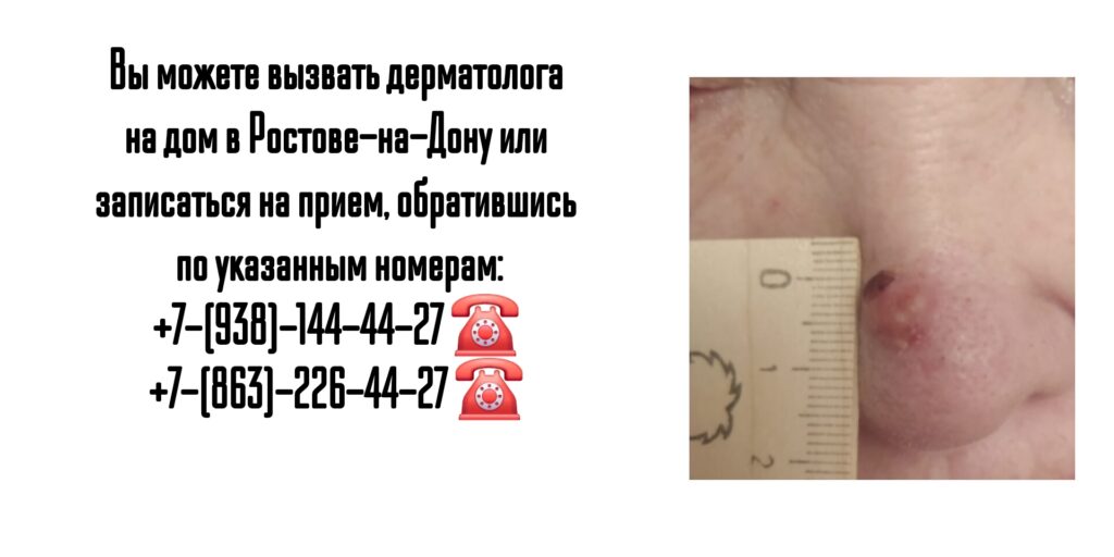 Вызов дерматолога на дом - Ростов-на-Дону 