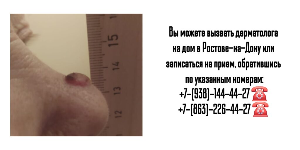 Вызов дерматолога на дом - Ростов-на-Дону 