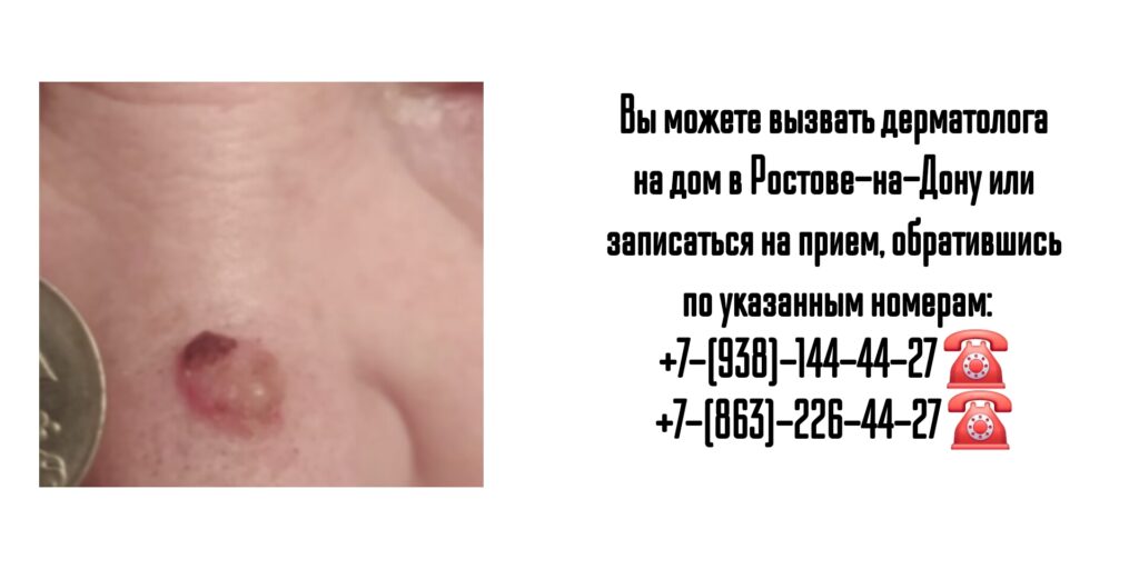 Вызов дерматолога на дом - Ростов-на-Дону 
