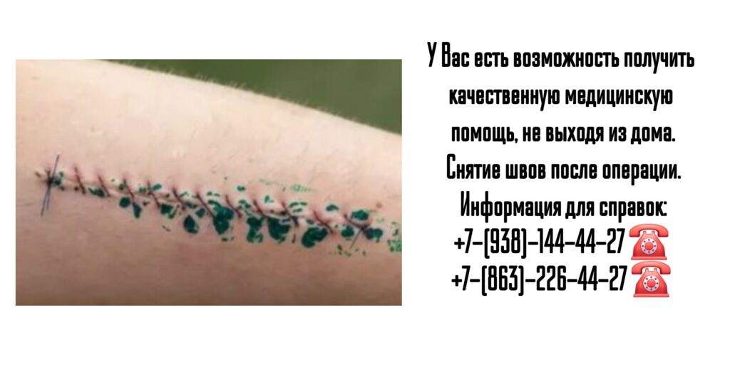 Снятие послеоперационных швов на дому в Ростове-на-Дону