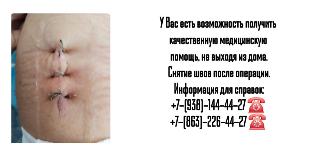 Снятие послеоперационных швов на дому в Ростове-на-Дону