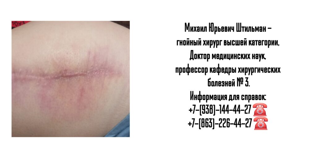 Штильман Михаил Юрьевич - Ростов гнойный хирург 
