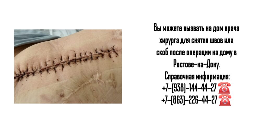 Ростов -на-Дону - снятие швов или скоб после операции 