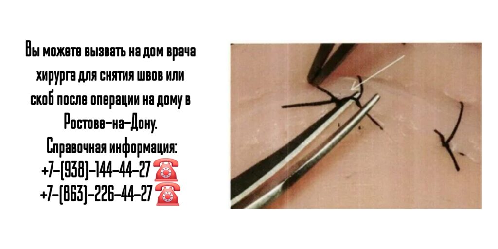 Ростов -на-Дону - снятие швов или скоб после операции 