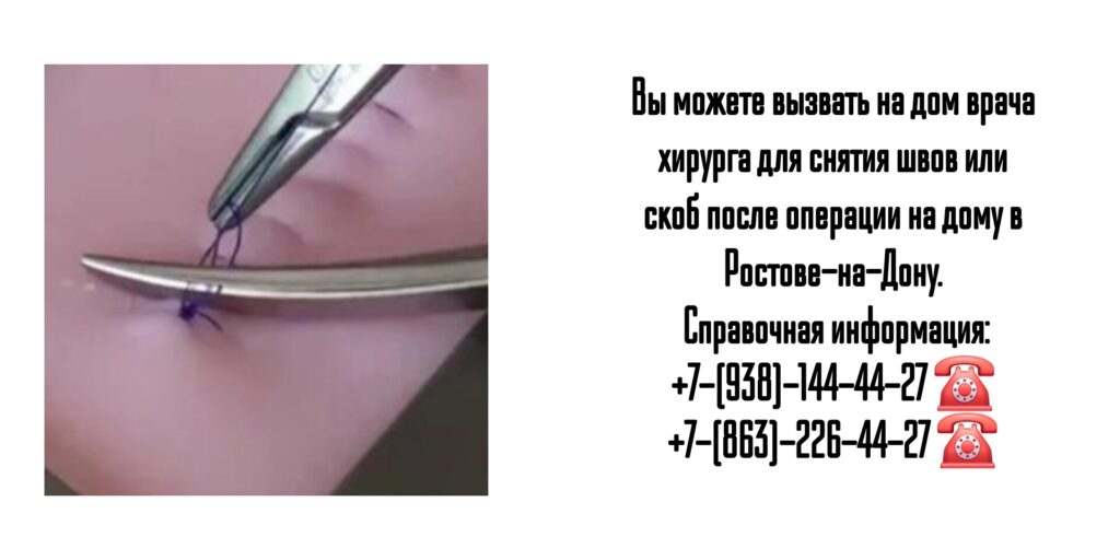 Ростов -на-Дону - снятие швов или скоб после операции 