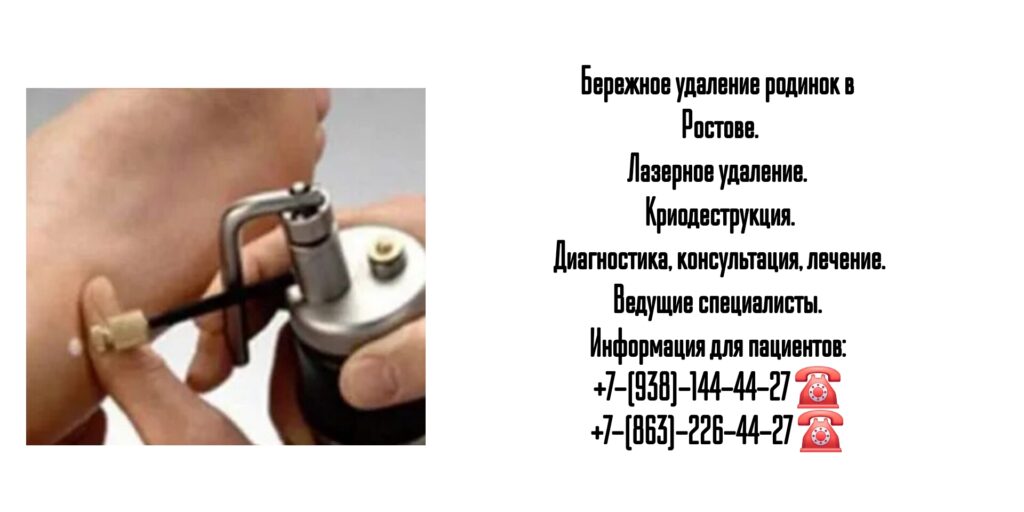 Криодеструкция в Ростове-на-Дону 