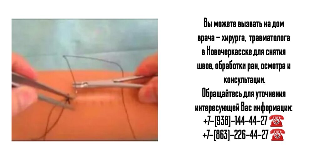 Снять швы на дому после операции в Новочеркасске
