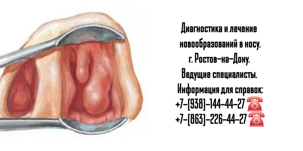 Исламова Елена Файзулаевна - Новообразование перегородки носа - биопсия Ростов-на-Дону 