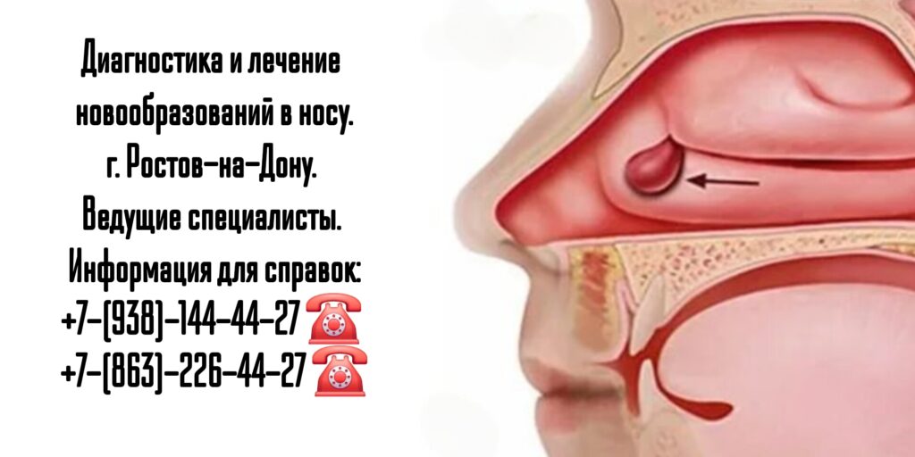 Исламова Елена Файзулаевна - Новообразование перегородки носа - биопсия Ростов-на-Дону 