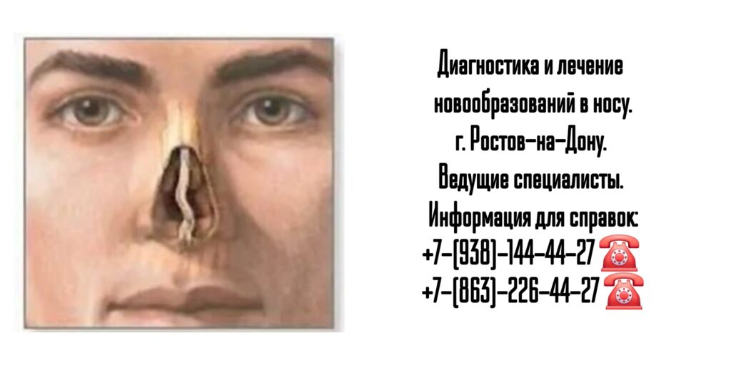 Исламова Елена Файзулаевна - Новообразование перегородки носа - биопсия Ростов-на-Дону 