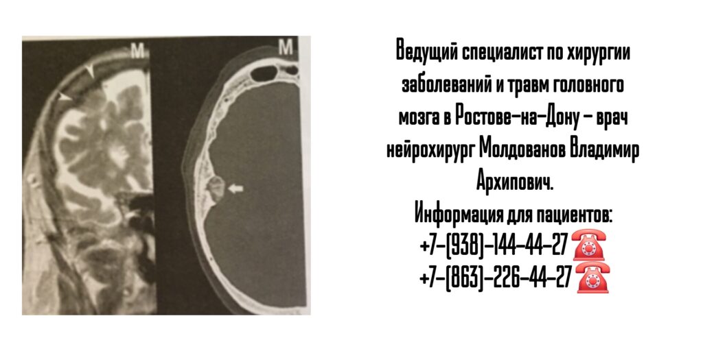 Ростов нейрохирург- Молдованов В.А.