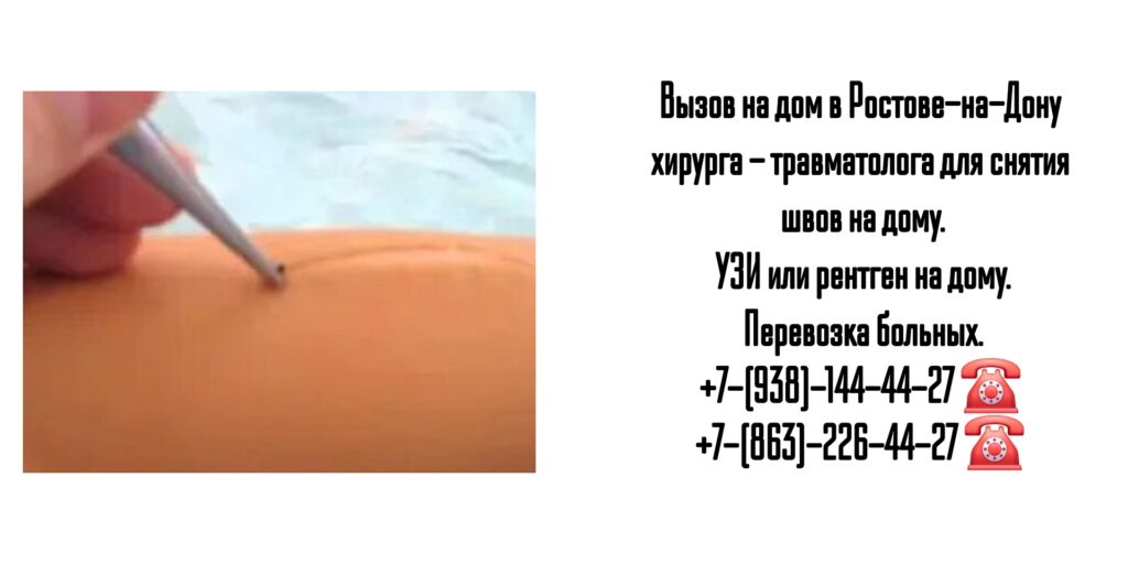 Снятие послеоперационных швов на дому - Ростов-на-Дону