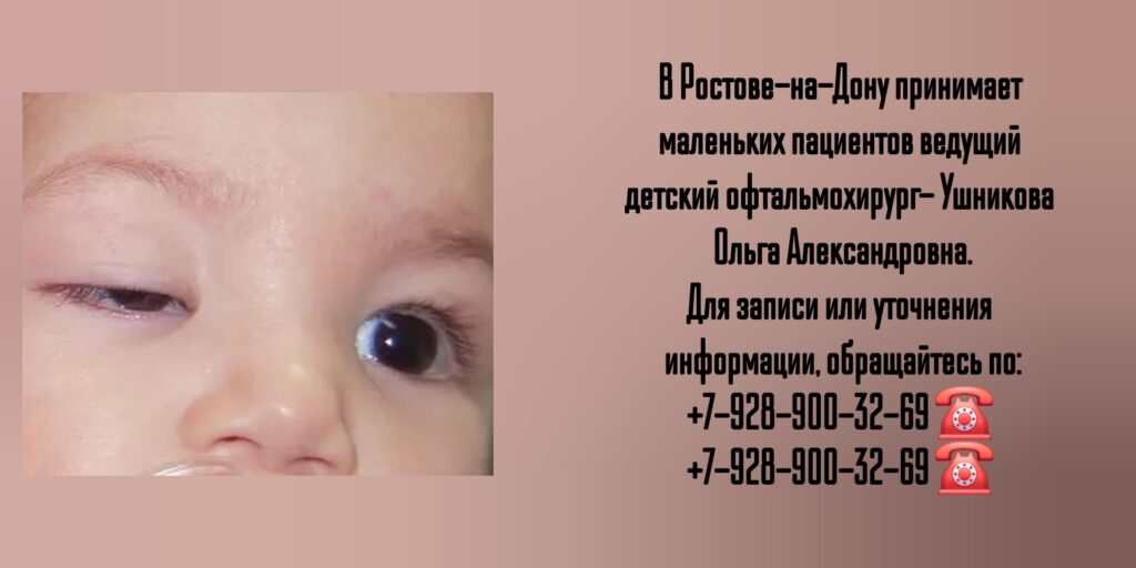 Птоз у детей - детский офтальмохирург в Ростове-на-Дону