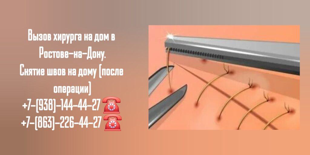 Снять швы на дому Ростов-на-Дону