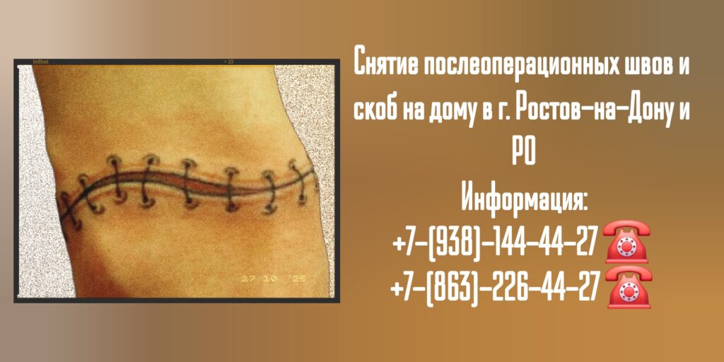 Снятие послеоперационных швов и скоб на дому - Ростов-на-Дону и РО