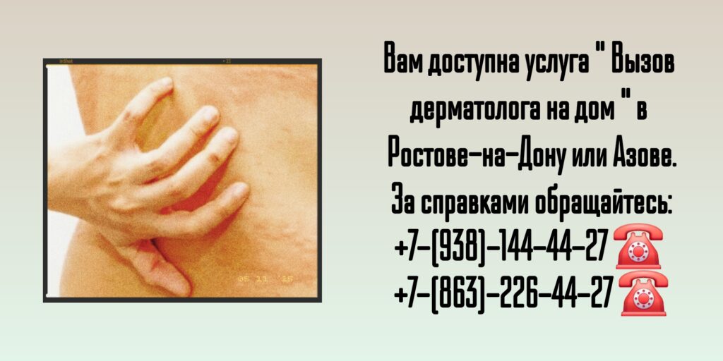 Вызов дерматолога на дом г Ростов-на-Дону и г Азов