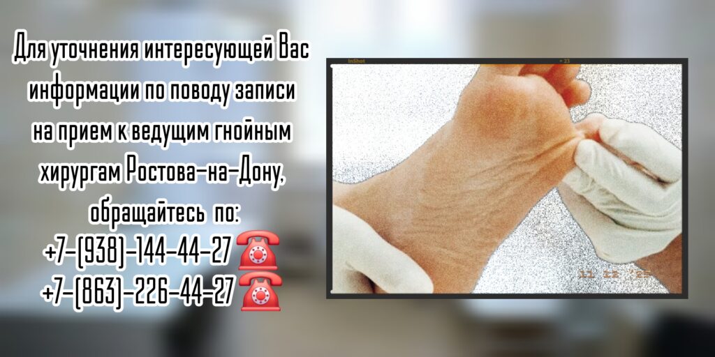 Диабетическая стопа - хирургическое лечение в Ростове-на-Дону - Штильман Михаил Юрьевич