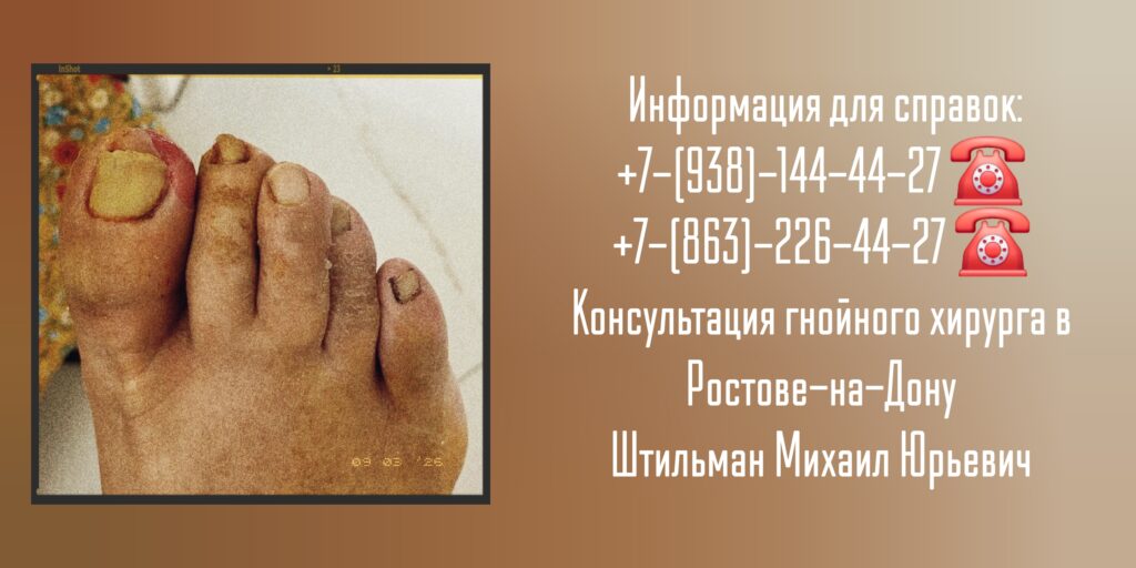 Михаил Юрьевич Штильман - Ростов Консультация гнойного хирурга