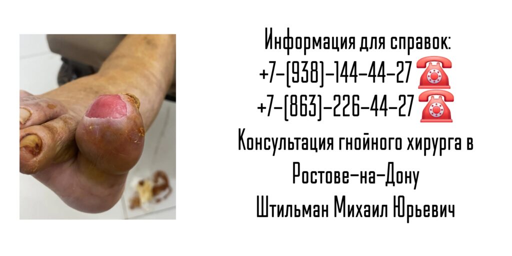 Михаил Юрьевич Штильман - Ростов Консультация гнойного хирурга