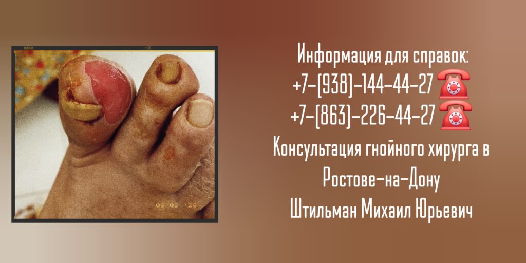 Михаил Юрьевич Штильман - Ростов Консультация гнойного хирурга