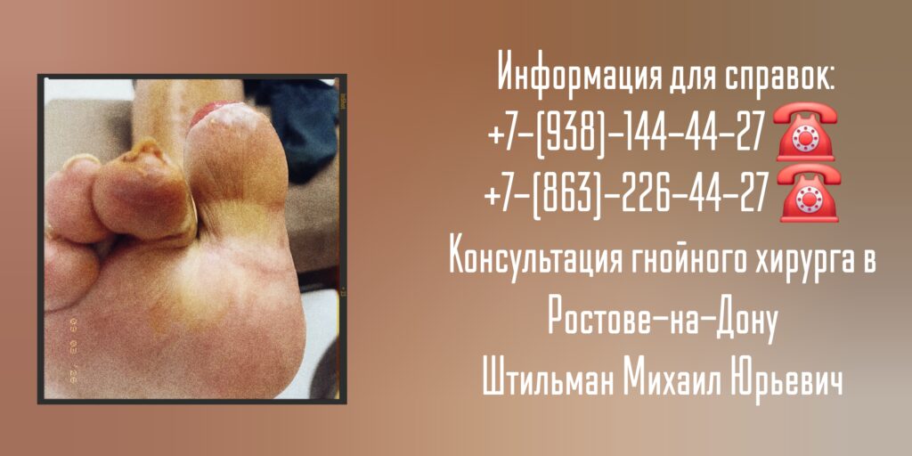 Михаил Юрьевич Штильман - Ростов Консультация гнойного хирурга