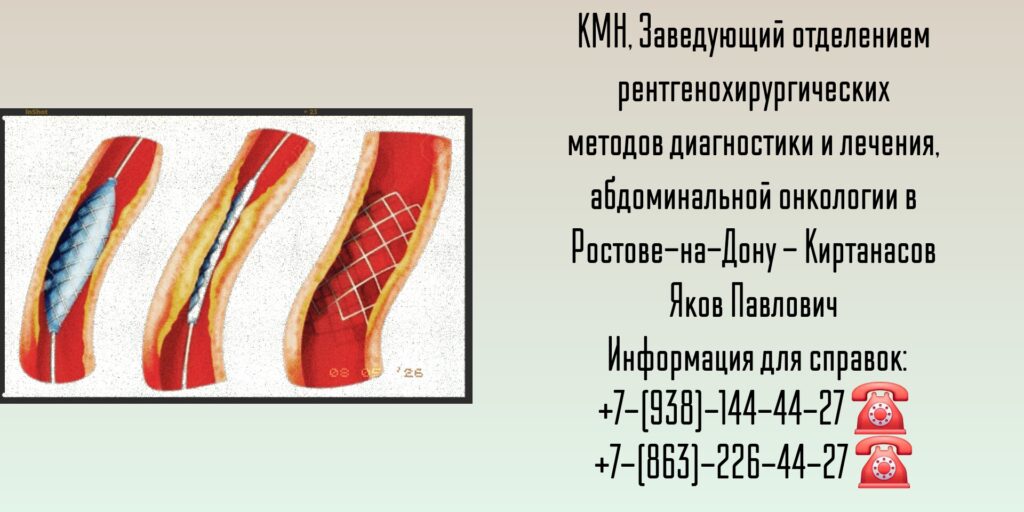 Малоинвазивный хирург Ростов-на-Дону - Киртанасов Яков Павлович